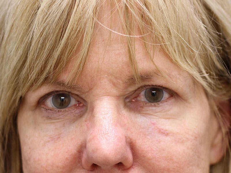 Eyelid Surgery