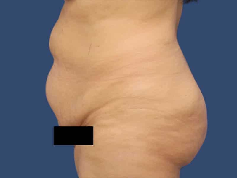 Tummy Tuck Before & After Gallery - Patient 54882391 - Image 5