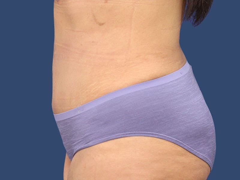 Tummy Tuck Before & After Gallery - Patient 54882391 - Image 6