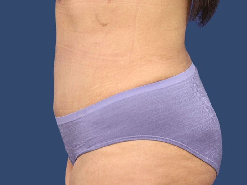Tummy Tuck Before & After Gallery - Patient 54882391 - Image 6