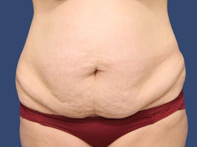 Tummy Tuck Before & After Gallery - Patient 54882393 - Image 1