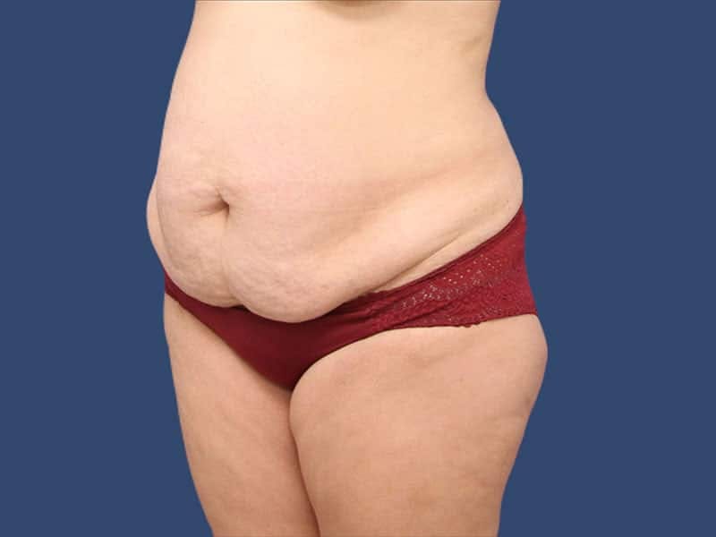 Tummy Tuck Before & After Gallery - Patient 54882393 - Image 3