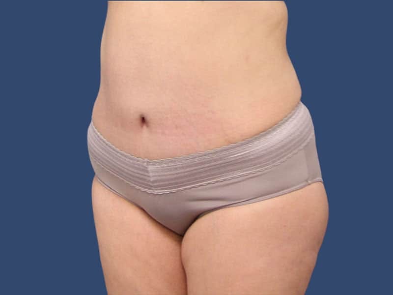 Tummy Tuck Before & After Gallery - Patient 54882393 - Image 4