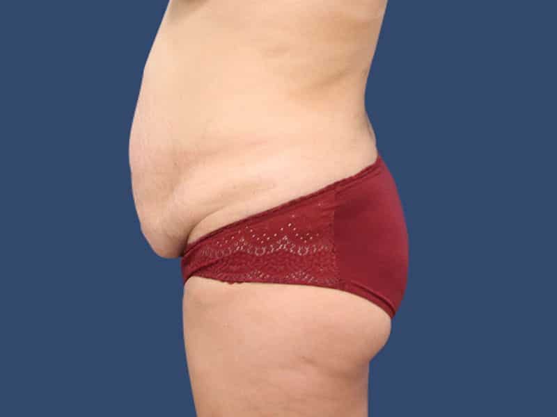 Tummy Tuck Before & After Gallery - Patient 54882393 - Image 5