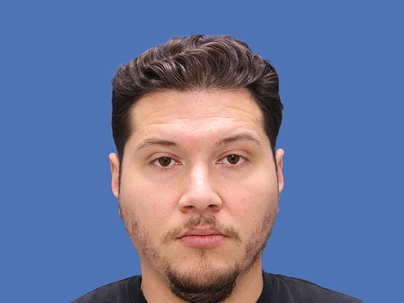 Rhinoplasty