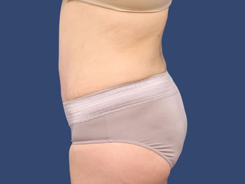 Tummy Tuck Before & After Gallery - Patient 54882393 - Image 6