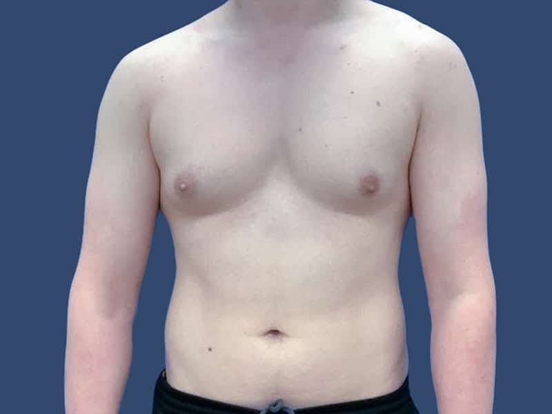 Gynecomastia Before & After Gallery - Patient 54882399 - Image 1