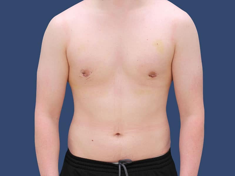 Gynecomastia Before & After Gallery - Patient 54882399 - Image 2
