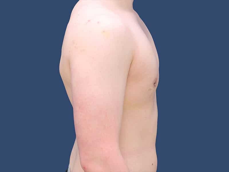 Gynecomastia Before & After Gallery - Patient 54882399 - Image 4