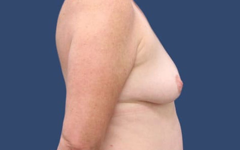 Breast Augmentation Before & After Gallery - Patient 55332381 - Image 3