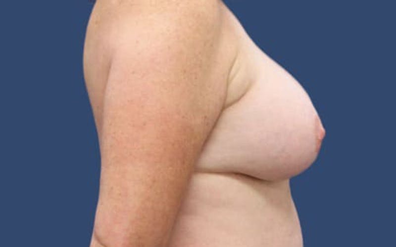 Breast Augmentation Before & After Gallery - Patient 55332381 - Image 4