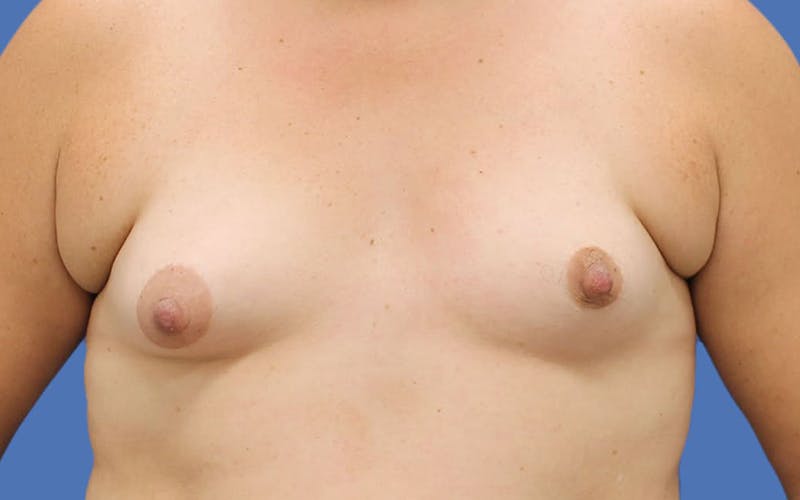 Breast Augmentation Before & After Gallery - Patient 55332605 - Image 1