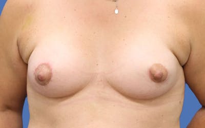 Breast Augmentation Before & After Gallery - Patient 55332605 - Image 2