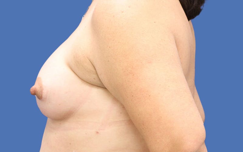 Breast Augmentation Before & After Gallery - Patient 55332605 - Image 6