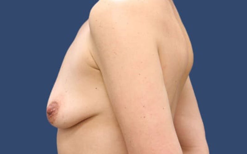 Breast Lift with Augmentation Before & After Gallery - Patient 55413624 - Image 3