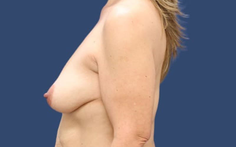 Breast Lift with Augmentation Before & After Gallery - Patient 55413625 - Image 3