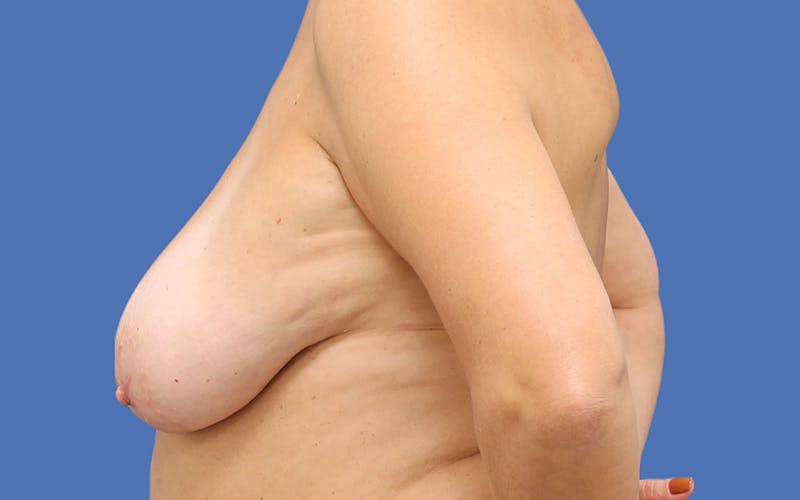 Breast Lift Before & After Gallery - Patient 55332614 - Image 5