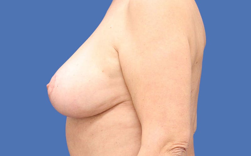 Breast Lift Before & After Gallery - Patient 55332614 - Image 6