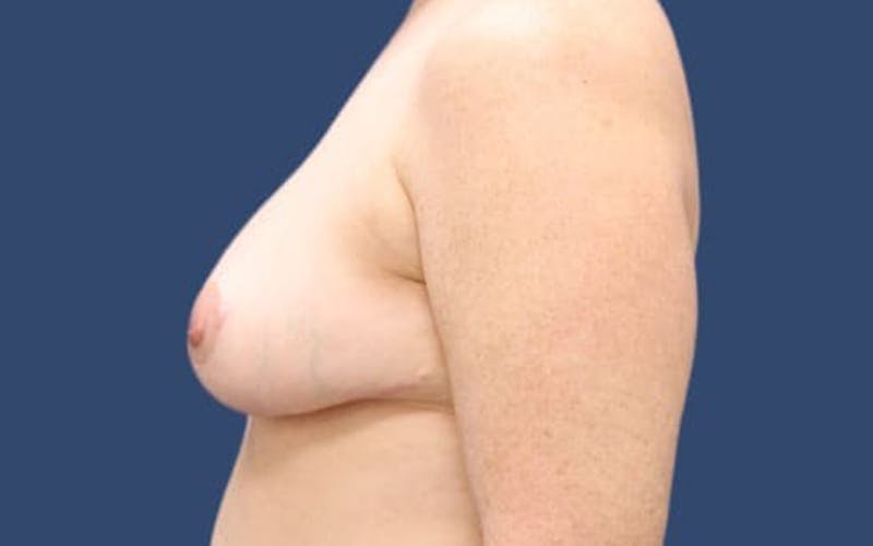 Breast Reduction Before & After Gallery - Patient 55332616 - Image 4