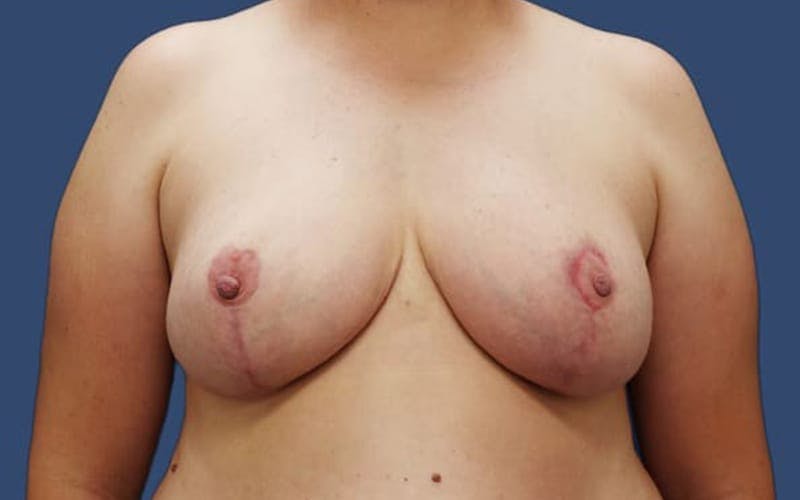 Breast Reduction in San Antonio Before & After Photos
