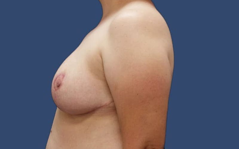 Breast Reduction Before & After Gallery - Patient 55332645 - Image 4