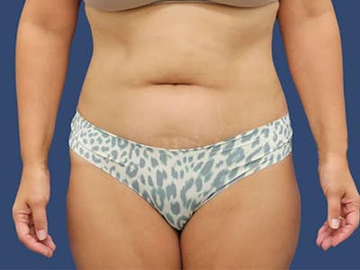 Tummy Tuck Before & After Gallery - Patient 54882389 - Image 1