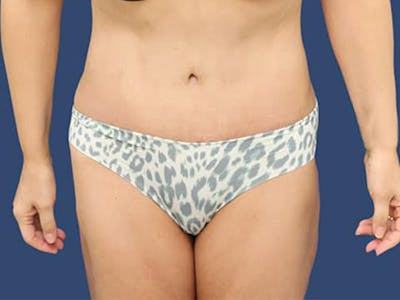 Tummy Tuck Before & After Gallery - Patient 54882389 - Image 2