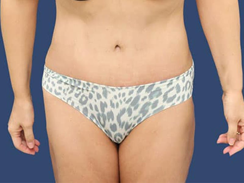 Tummy Tuck Before & After Gallery - Patient 54882389 - Image 2