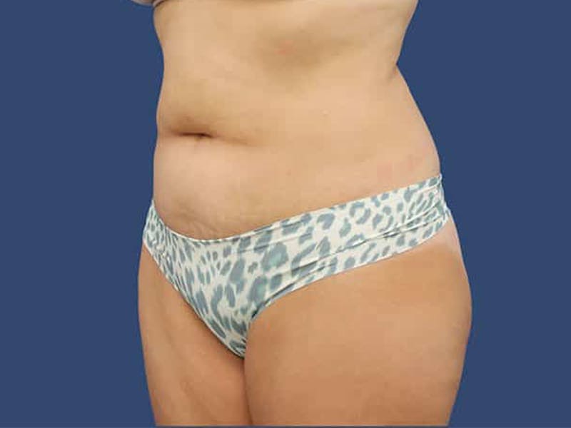 Tummy Tuck Before & After Gallery - Patient 54882389 - Image 3