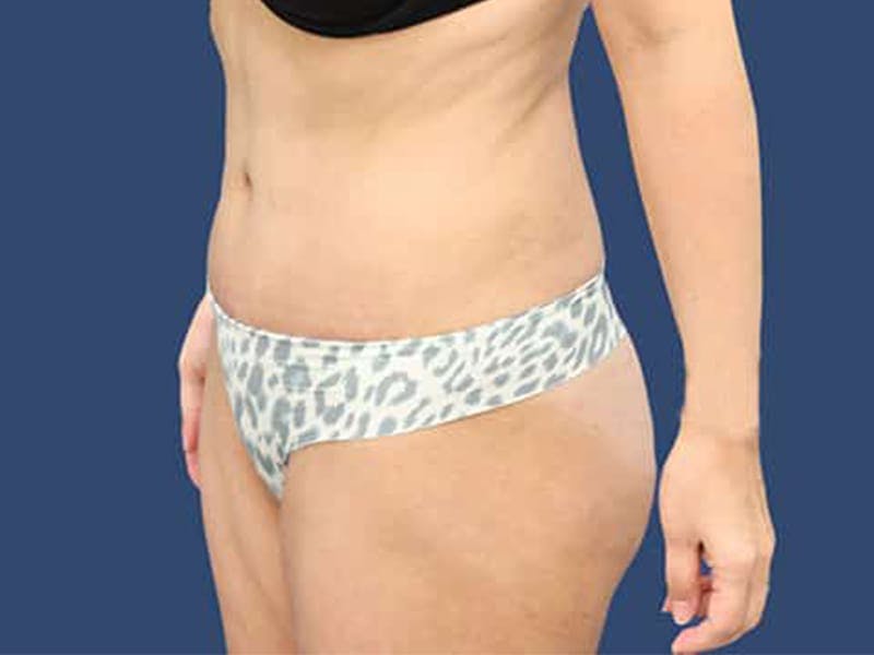 Tummy Tuck Gallery - Patient 54882389 - Image 4
