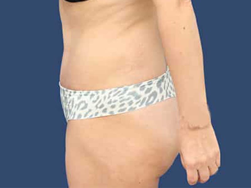 Tummy Tuck Gallery - Patient 54882389 - Image 6