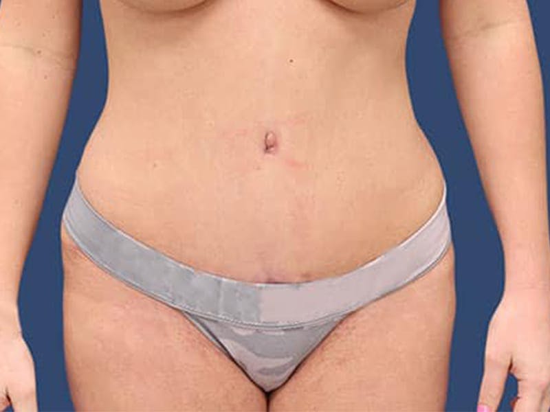 Tummy Tuck Before & After Gallery - Patient 54882395 - Image 2