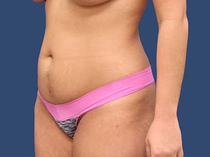 Tummy Tuck Before & After Gallery - Patient 54882395 - Image 3