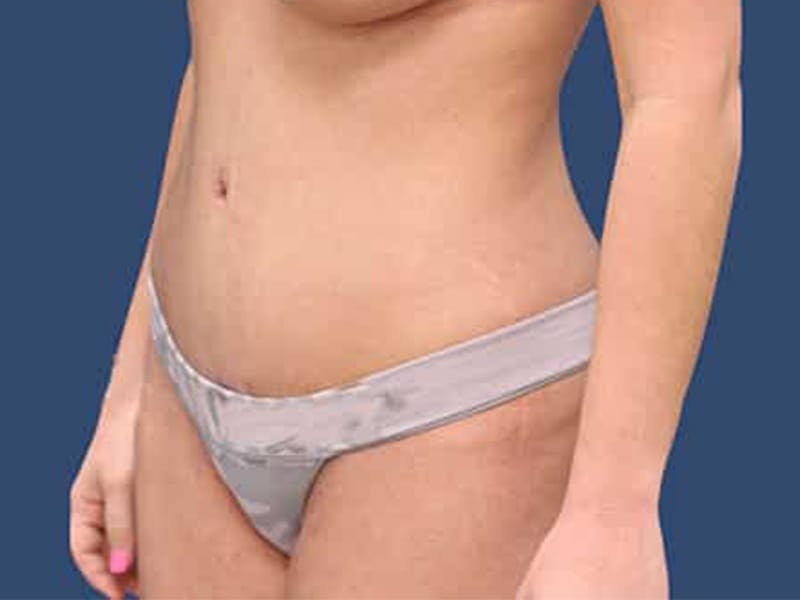 Tummy Tuck Gallery - Patient 54882395 - Image 4