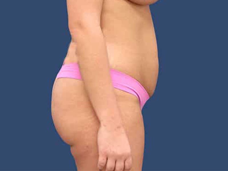 Tummy Tuck Before & After Gallery - Patient 54882395 - Image 5