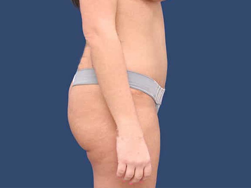 Tummy Tuck Before & After Gallery - Patient 54882395 - Image 6