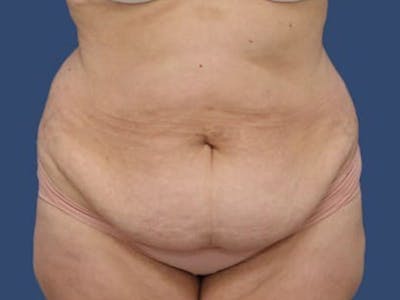 Tummy Tuck Before & After Gallery - Patient 55333018 - Image 1