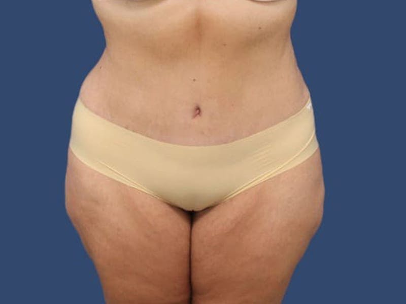 Tummy Tuck Before & After Gallery - Patient 55333018 - Image 2