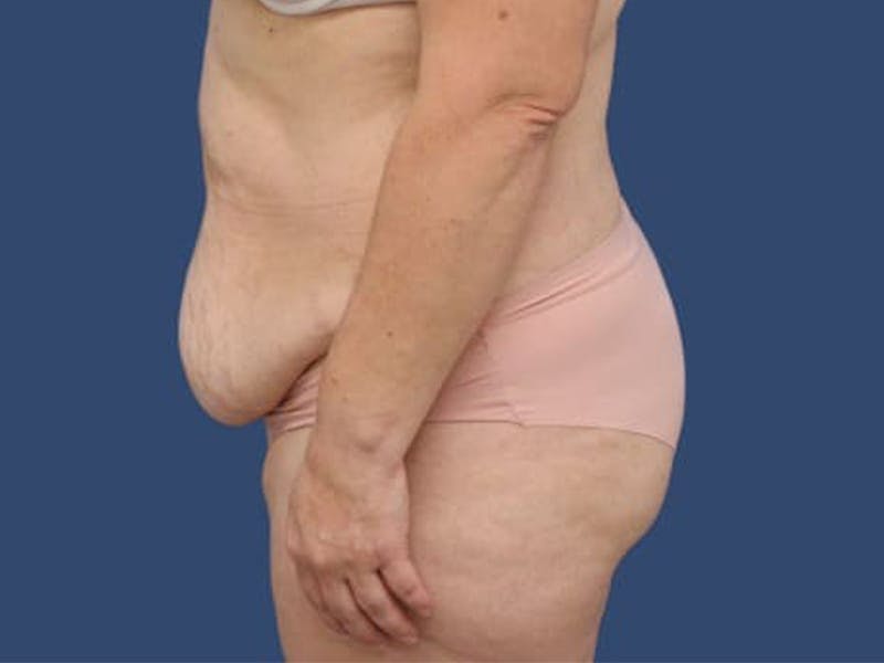 Tummy Tuck Before & After Gallery - Patient 55333018 - Image 3