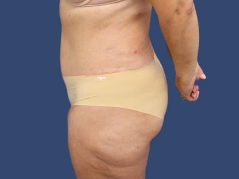 Tummy Tuck Before & After Gallery - Patient 55333018 - Image 4