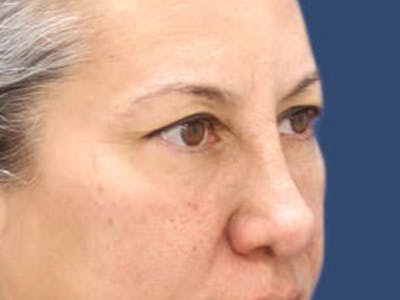 Eyelid Surgery Before & After Gallery - Patient 55332948 - Image 1