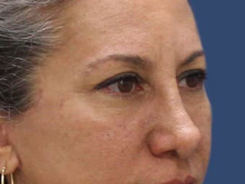 Eyelid Surgery Before & After Gallery - Patient 55332948 - Image 2