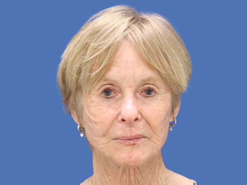 Neck Lift Before & After Gallery - Patient 55418742 - Image 3