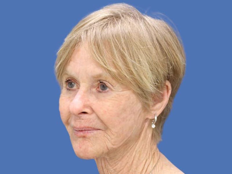Facelift Before & After Gallery - Patient 55332953 - Image 3
