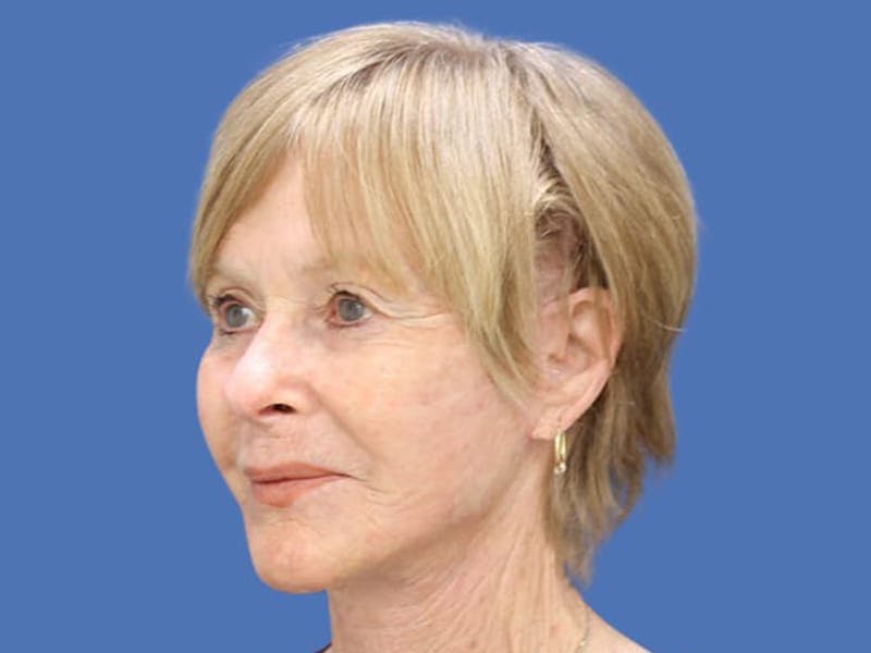 Facelift Before & After Gallery - Patient 55332953 - Image 4