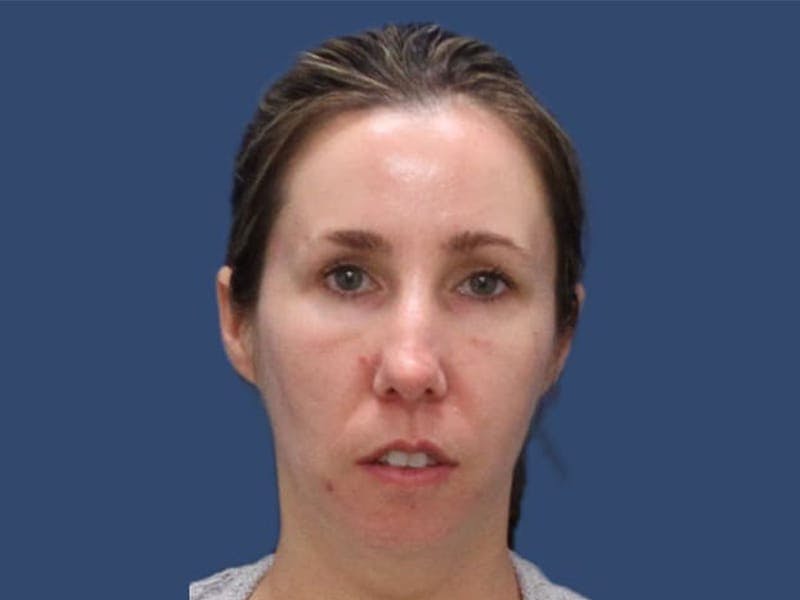 Facial Implant Before & After Gallery - Patient 55347908 - Image 1