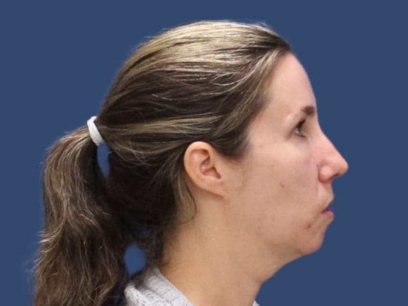 Facial Implant Gallery - Patient 55347908 - Image 3