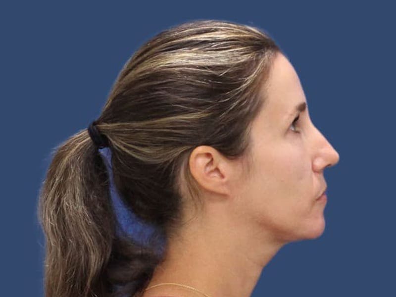 Facial Implant Before & After Gallery - Patient 55347908 - Image 4