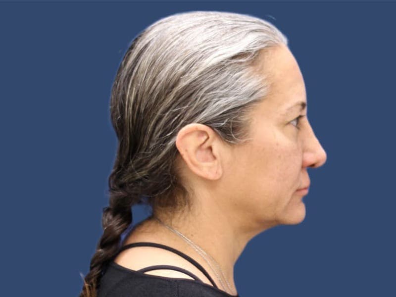 Neck Lift Before & After Gallery - Patient 55413431 - Image 3
