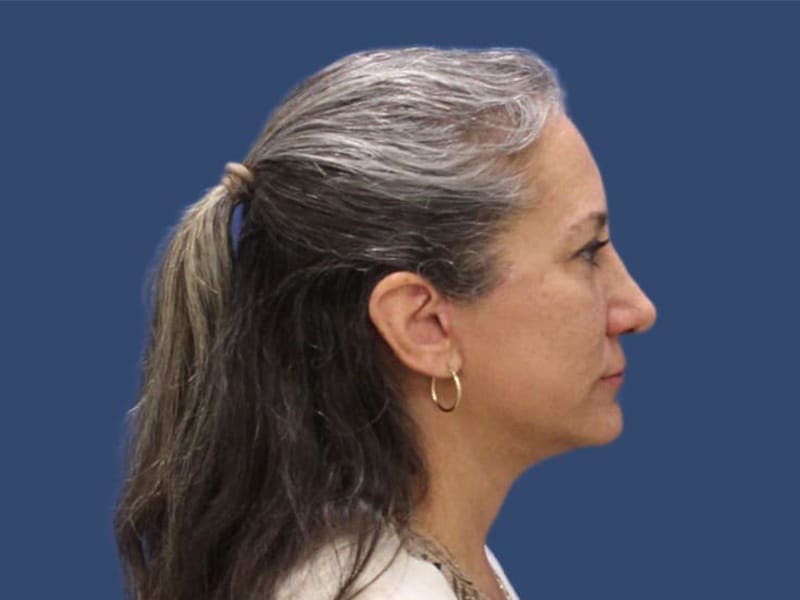 Neck Lift Before & After Gallery - Patient 55413431 - Image 4